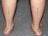 đế chỉnh hình điều trị bàn chân bẹt 