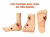 cắt cụt do tiểu đường