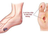 chăm sóc cắt cụt chi do tiểu đường