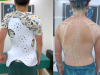 áo chỉnh hình điều trị cong vẹo cột sống