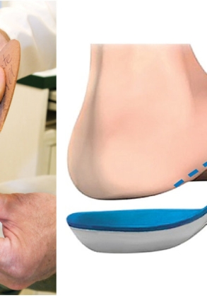 Nẹp nắn chỉnh bàn chân bẹt