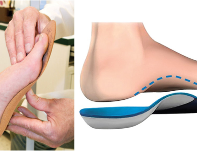Nẹp nắn chỉnh bàn chân bẹt