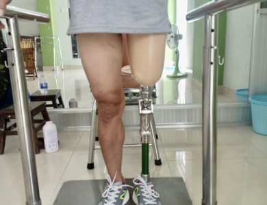 Chân giả trên gối