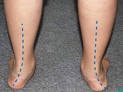 đế chỉnh hình điều trị bàn chân bẹt 