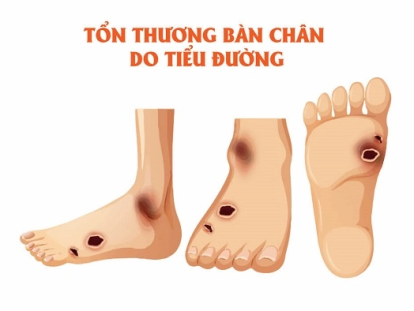 cắt cụt do tiểu đường