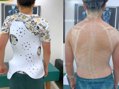 áo chỉnh hình điều trị cong vẹo cột sống