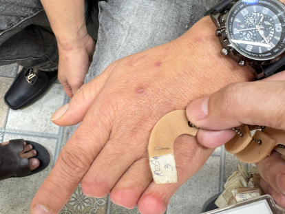 làm ngón tay giả