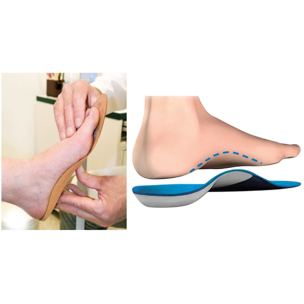 Nẹp nắn chỉnh bàn chân bẹt