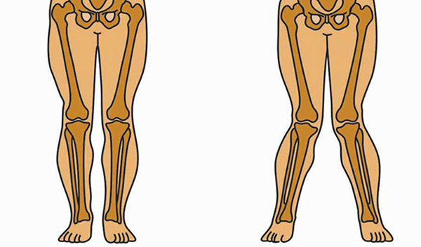 dấu hiệu bàn chân bẹt lệch trục