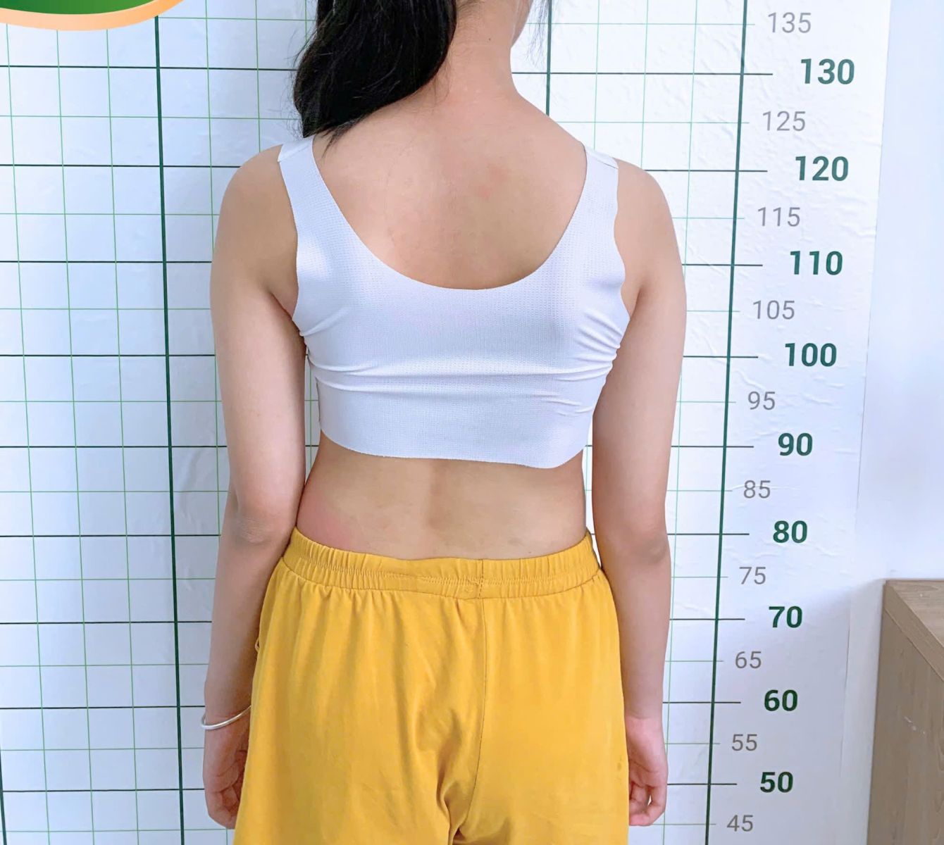 cong vẹo cột sống