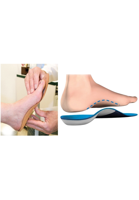 Nẹp nắn chỉnh bàn chân bẹt