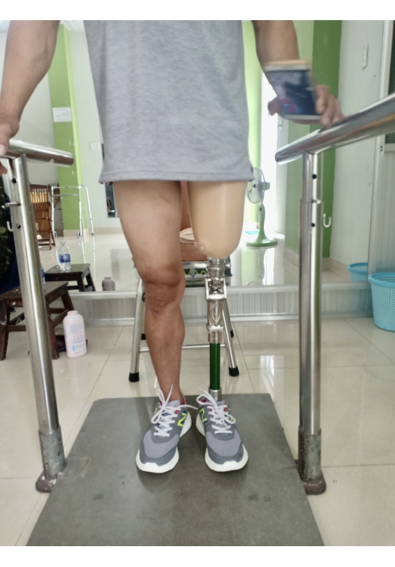 Chân giả trên gối