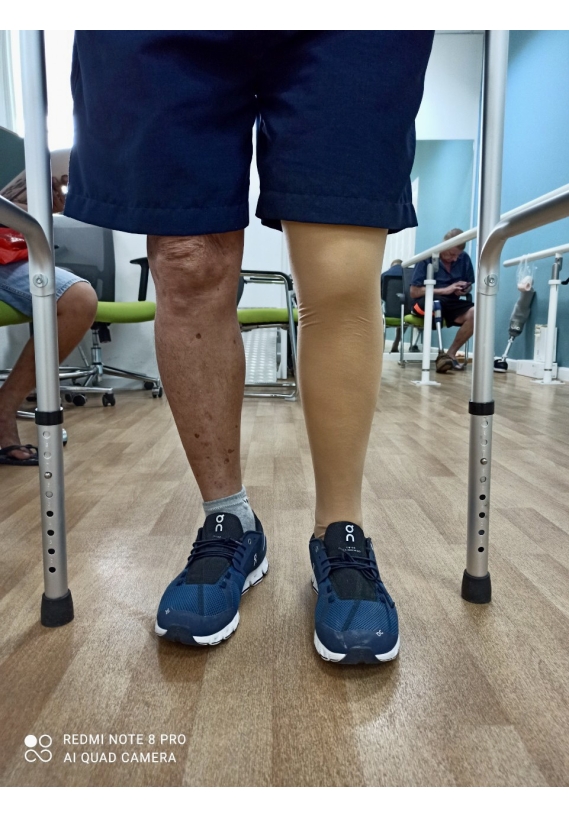 Chân giả trên gối
